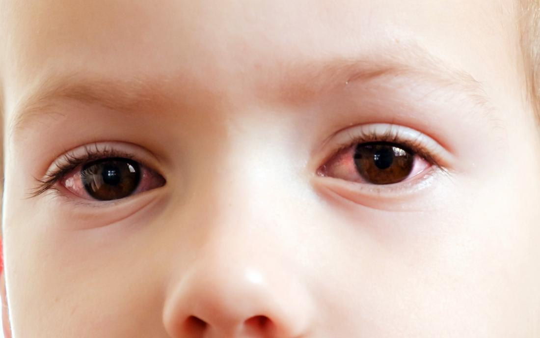 Read more about the article Symptoms of cataracts in children